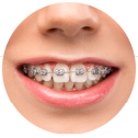Traditional metal braces